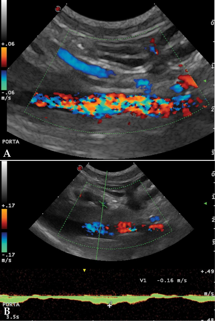 <p>(A) Corte longitudinal a nivel del hilio hepático. Doppler color. Vena porta con flujo hepatófugo. (B) Patrón del flujo portal con Doppler espectral. Ilustra el flujo de la vena porta en dirección hepatófuga y con la velocidad reducida.</p>