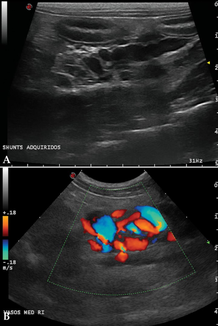 <p>(A) Corte longitudinal, medial al riñón izquierdo. Múltiples vasos sanguíneos distendidos y tortuosos compatibles con shunts portosistémicos extrahepáticos adquiridos. (B) Corte longitudinal, medial al riñón izquierdo. Detalle Doppler color.</p>
