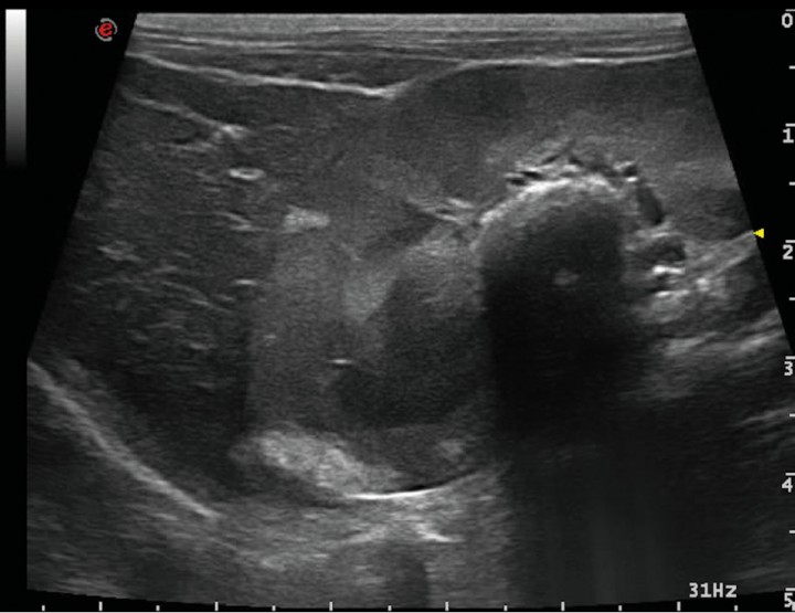 <p>Corte longitudinal a nivel del riñón derecho - hígado. Área hiperecoica con marcada sombra acústica en región de pelvis renal (urolitiasis) y múltiples áreas hiperecoicas de forma acuñada, sin sombra acústica en región cortical (infartos renales).</p>