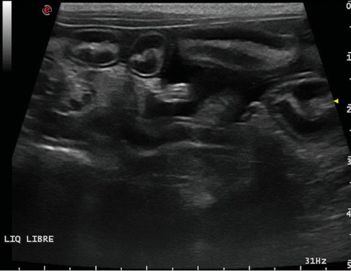 <p>Corte longitudinal. Líquido libre abdominal anecoico entre asas de intestino delgado.</p>