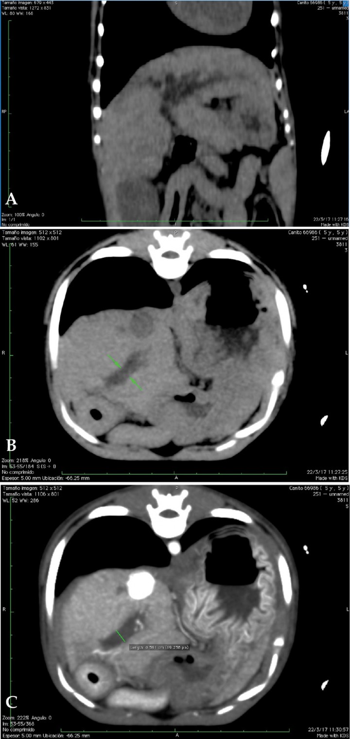 <p>(A) Reconstrucción multiplanar (MPR) en plano dorsal en ventana de tejido blando. Imagen sin contraste. Se identifican, hipodensos, los conductos biliares dilatados. (B y C) Imágenes axiales pre y postcontraste del conducto biliar común distendido, sin evidencias de obstrucción mecánica del mismo.</p>