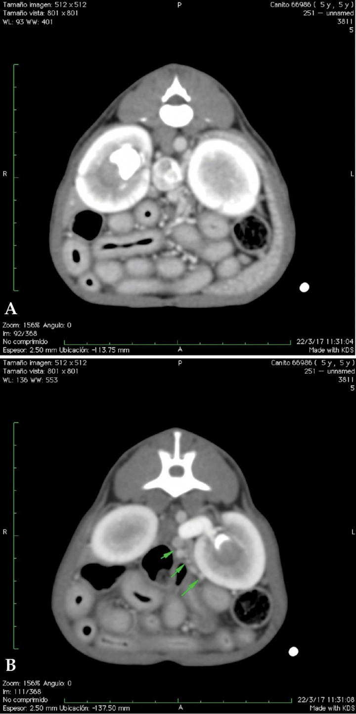 <p>Imágenes axiales con contraste a nivel renal. (A) Dilatación de la vena cava con múltiples vasos sanguíneos tortuosos adyacentes (shunts portosistémicos adquiridos), urolito en pelvis del riñón derecho. Áreas estriadas hipodensas (captación de contraste irregular) en ambas corticales renales. (B) Dilatación de la vena renal izquierda y pequeños vasos sanguíneos de aspecto tortuosos en la proximidad del riñón izquierdo (shunts portosistémicos adquiridos). Urolito en pelvis del riñón izquierdo. </p>