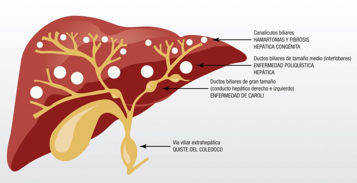 <p>Las vías biliares intra y extrahepa?ticas se originan en una estructura embrionaria denominada placa ductal; los defectos en su remodelacio?n o su persistencia, dan origen a malformaciones que suelen tener diferentes expresiones y cuadros clínicos dependiendo del momento del desarrollo en el que se produzca y de la parte de la vía biliar afectada. La fibrosis hepática congénita y los hamartomas biliares son manifestaciones de la malformación de los pequeños ductos o canalículos biliares, la enfermedad poliquística representa la malformación de los ductos biliares intrahepáticos de mediano tamaño, la enfermedad de Caroli es el resultado de la malformación de los ductos biliares de gran tamaño y los quistes de cole?doco son resultado de la alteración de los ductos biliares extrahepa?ticos. La enfermedad de Caroli puede ocurrir también en asociación con la fibrosis hepática congénita, siendo llamada entonces síndrome de Caroli.</p>