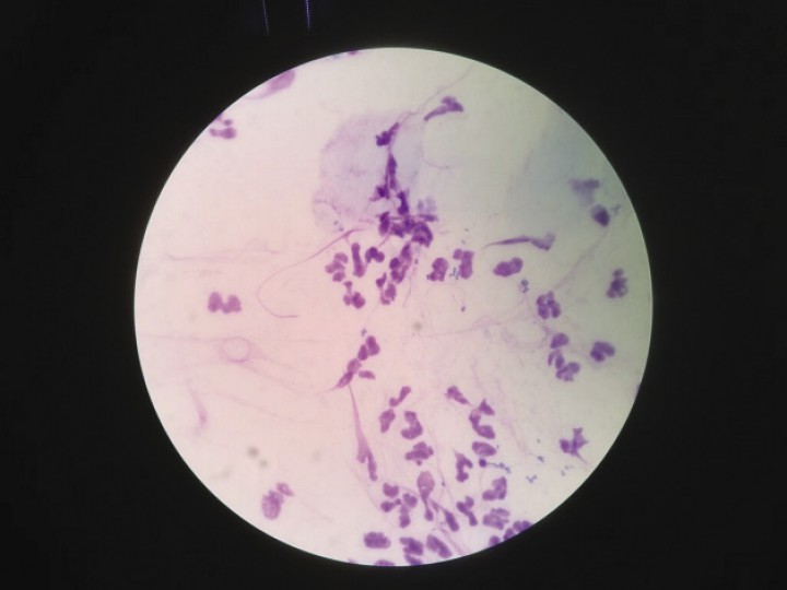 <p>Presencia de bacterias del género <em>Simonsiella spp</em>. en la citología de un paciente con dermatitis acral. Tinción panóptico rápido x 100.</p>