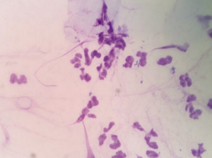 <p>Citología de un paciente con dermatitis acral, evidenciando la presencia de una pioderma. Tinción panóptico rápido x 100.</p>