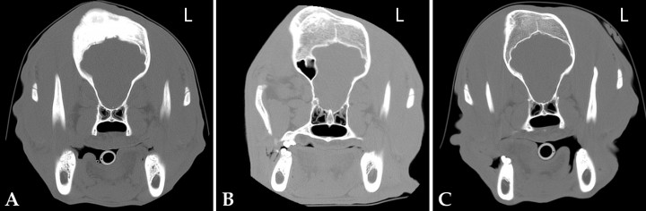<p>Imágenes de Tomografía Computarizada en plano transversal realizadas en ventana hueso. (A) Momento del diagnóstico. El hueso frontal derecho se observa moderadamente engrosado, además se observa una reacción perióstica fusiforme y aumento de la densidad del hueso de forma heterogénea. (B) A los 6 meses después del diagnóstico; la lesión ósea presenta reducción de la atenuación ósea y remodelación en el hueso frontal derecho. (C) A los 2 años de edad del paciente. La lesión presenta una pequeña disminución de tamaño y reducción de la atenuación ósea respecto al estudio anterior.</p>