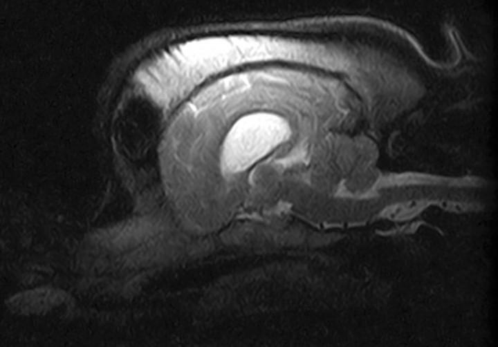 <p>Imagen de Resonancia Magnética, plano sagital en T2. No se observan lesiones en estructuras adyacentes.</p>