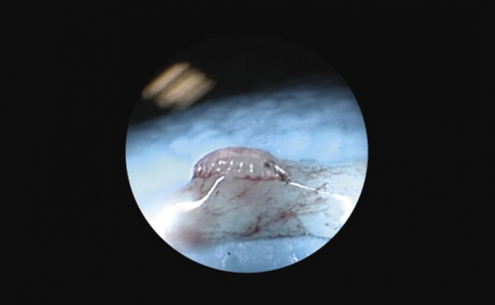 <p>Imagen macroscópica de una de las L2 de <em>O. ovis</em> aislada del paciente.</p>