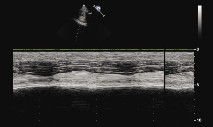<p>M-mode ultrasonography image of the left hemidiaphragm for the dog in Figure 1 shows absence of diaphragmatic movement.</p>