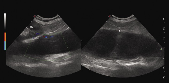 <p>Corte sagital en ecografía mediante un abordaje lateral derecho del dorso del abdomen, donde se observa una gran cantidad de líquido encapsulado, con algo de celularidad en suspensión, yuxtapuesto a las vértebras lumbares y dorsal al riñón derecho (RD), que no muestra alteraciones por su parte. En la exploración Doppler sólo se observa neovascularización en la cápsula de la lesión.</p>