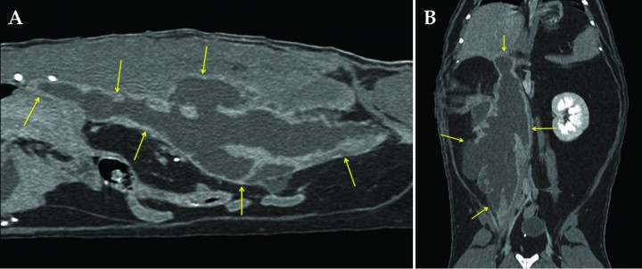<p>Imágenes de Tomografía Computarizada en (A) corte sagital y (B) dorsal de la cavidad abdominal post-contraste ventana de tejido blando mostrando el absceso en su extensión máxima (flechas amarillas). Se observa la cápsula con marcado realce en la mayor parte de la extensión de la lesión, que no sólo se circunscribe a la porción ventral de la musculatura espinal, sino que también se proyecta dorsal entre los procesos transversos de las vértebras lumbares 3 a 5 aproximadamente.</p>