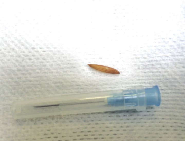 <p>Detalle del fragmento de espiga encontrado en la cirugía comparado con el tamaño de una aguja azul.</p>