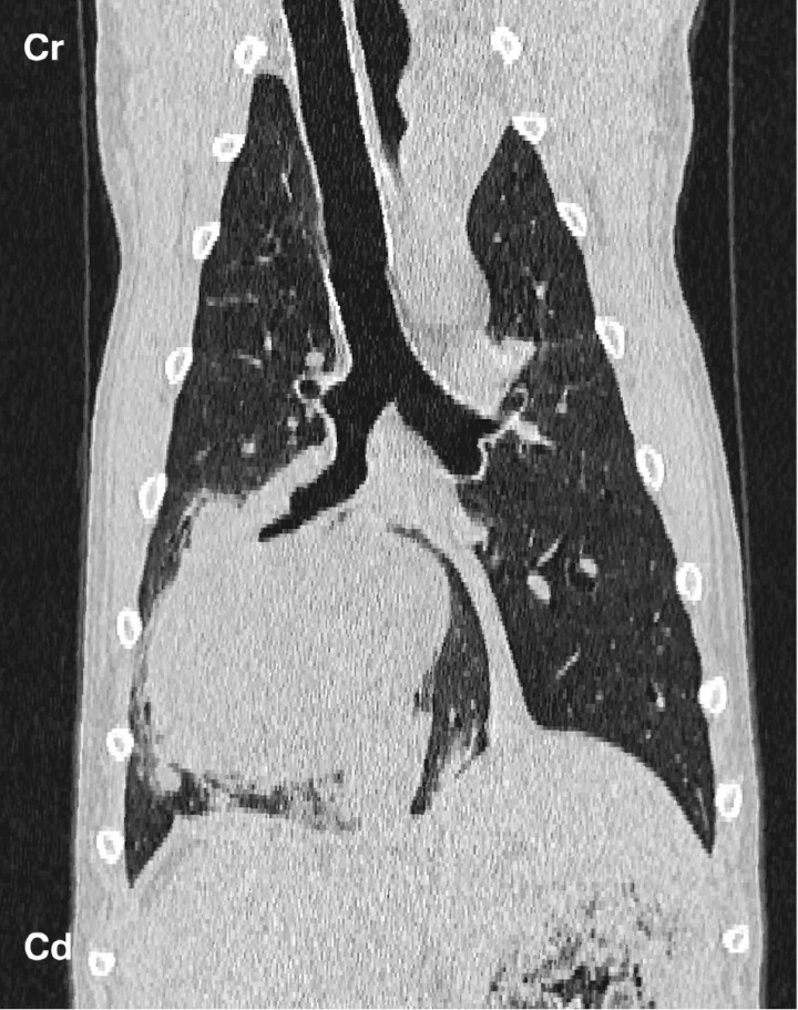 <p>Dorsal plane reconstructed lung window CT image consistent with a broncoalveolar carcinoma. Note the solitary, well circumscribed, soft tissue attenuating lung mass in the right caudal lung lobe. The lobar bronchus is narrowed and displaced laterally. Ground-glass opacities are present at the periphery of the mass, most likely consistent with local tumour infiltration. Cr: cranial. Cd: caudal.</p>