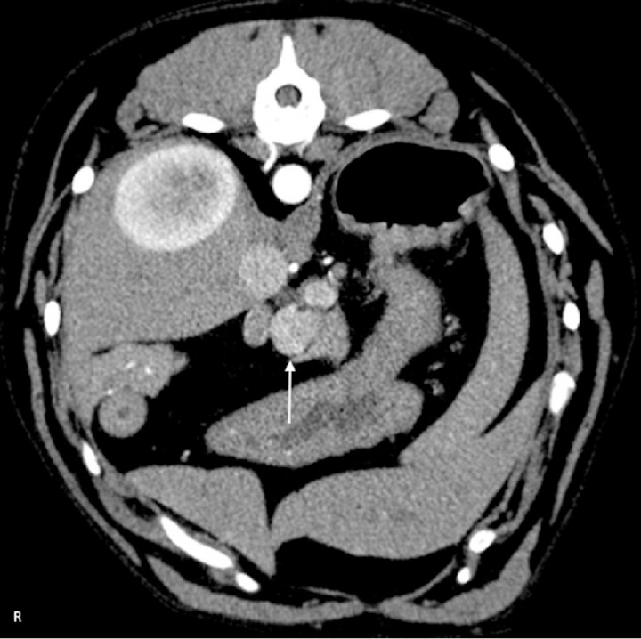 <p>CT angiogram transverse soft tissue window image in arterial post contrast phase of an 8 year-old German Pinscher. There is a rounded, contrast enhancing mass (white arrow) at the level of the pancreatic body, compatible with an insulinoma. The mass is hyperattenuating to the pancreas during the arterial phase. R: right.</p>