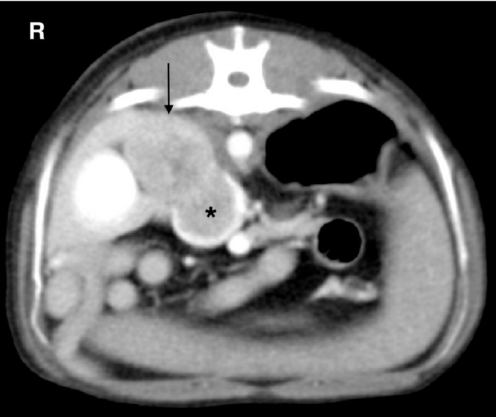 <p>Adrenal gland carcinoma with severe invasion of the caudal vena cava. CT angiogram transverse image in soft tissue window. Note the large mass at the level of the right adrenal gland (arrow) and the large filling defect within the caudal vena cava (black asterisk) at the same level. R: right.</p>