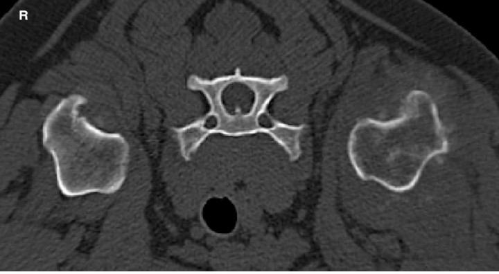 <p>8 year-old German Shepherd Dog with a primary bone tumour at the level CT transverse image of the metaphysis of the left humerus in bone window showing a mixed productive and osteolytic aggressive bone lesion with multifocal cortical destruction. R: right.</p>