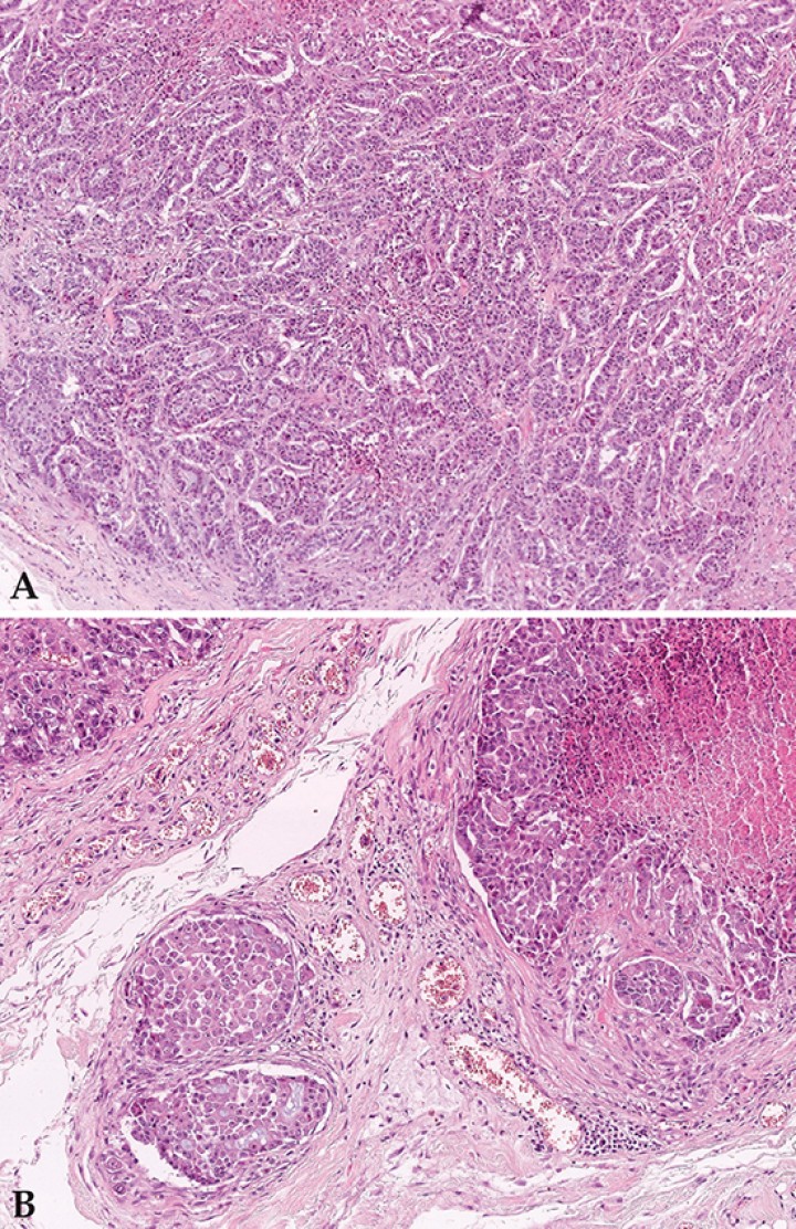 <div class=\"Basic-Text-Frame\">
<p>Imagen microscópica de la glándula mamaria. (A) Carcinoma mamario mostrando un patrón tubulopapilar (HE 100x). (B) Áreas de comedocarcinoma (HE 200x).</p>
</div>