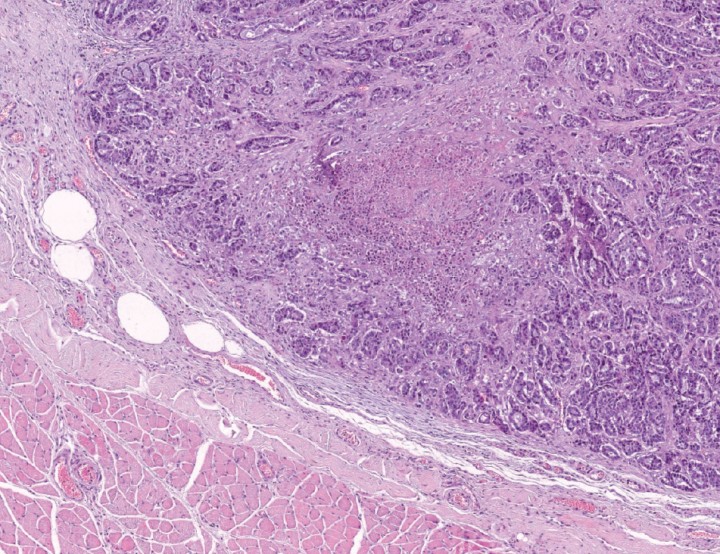 <div class=\"Basic-Text-Frame\">
<p>Imagen microscópica del músculo esquelético (extremidad posterior izquierda). Se aprecia un nódulo intramuscular metastásico de carcinoma mamario (HE 40x).</p>
</div>
