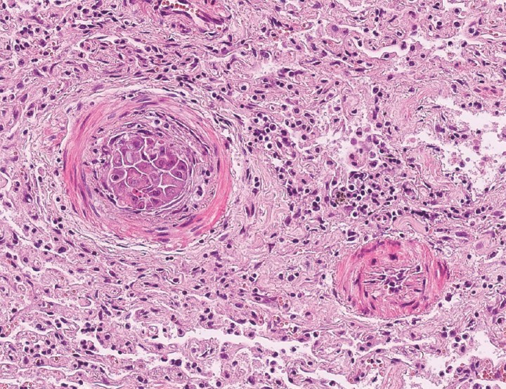 <p>Imagen microscópica del pulmón. Se observan células epiteliales neoplásicas en la luz de arteriolas pulmonares (HE 400x).</p>