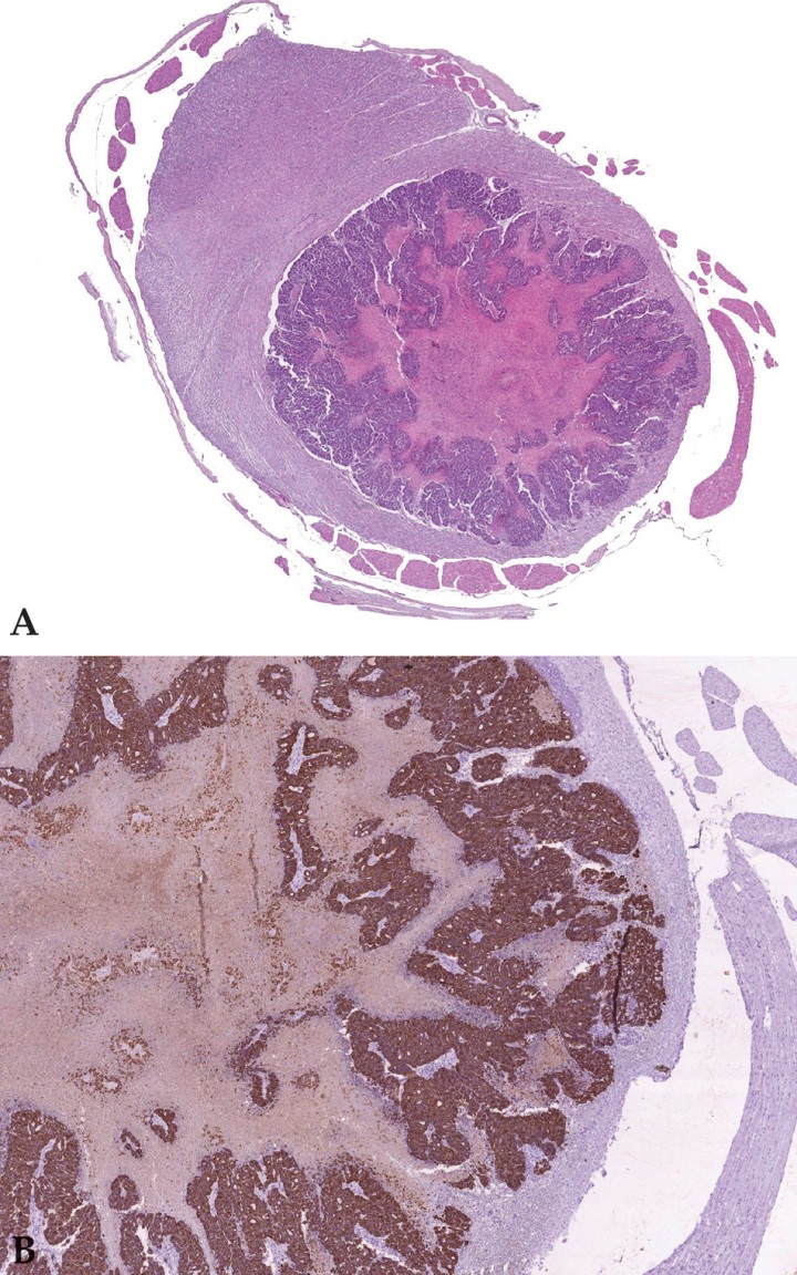 <p>Imagen microscópica de la médula espinal a nivel de L2. (A) Se aprecia metástasis intramedular de carcinoma mamario (HE 20x). (B) Se observan células neoplásicas intensamente positivas para citoqueratina. Inmunohistoquímica para CK AE1/AE3, contrateñido con hematoxilina x40.</p>