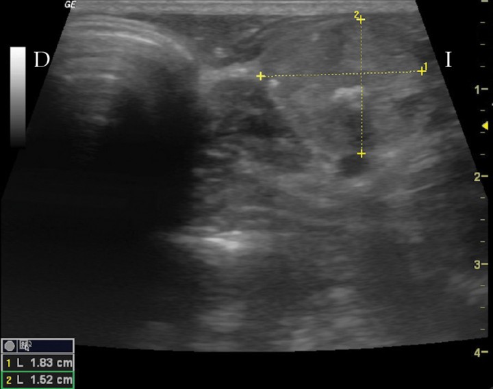 <p>Imagen ecográfica en plano transversal de la masa cervical. D: derecha. I: izquierda.</p>