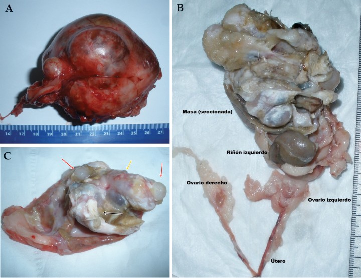 <p>(A) Imagen macroscópica de la masa extirpada con la cápsula. (B) Imagen macroscópica de la masa una vez decapsulada. Se observa caudalmente el riñón izquierdo (con morfología normal, pero menor tamaño) y cranealmente la estructura desorganizada que componía la neoplasia. Como se puede observar en la imagen, el ovario izquierdo estaba íntimamente ligado a la cápsula del tumor. (C) Se pueden observar zonas con presencia de pelo (flecha negra), tejido articular (flechas rojas) y hueso (flecha amarilla).</p>