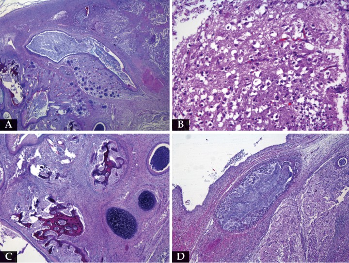 <p>Imágenes microscópicas. (A) Se puede observar que el tumor está constituido por tejido óseo (ángulo inferior izquierdo) y tejido cutáneo con abundantes acúmulos de queratina (área central), mientras que en los márgenes de la imagen se visualizan restos de tejido adrenal (HE x 2,5). (B) Se puede observar tejido nervioso. Se identifica un tejido muy desorganizado, constituido por neuronas y células gliales (HE x 20). (C) Algunas áreas del tumor están constituidas por tejido cartilaginoso y óseo (HE x 5). (D) En la parte central de la imagen se observa una estructura elipsoide con una luz central que aparece tapizada por epitelio simple cilíndrico con células caliciformes y que podría corresponder a intestino (HE x 5).</p>