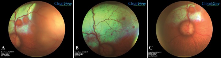 <p>(A) Exploración mediante oftalmoscopia directa OD. (B) Exploración mediante oftalmoscopia directa OS. (C) Detalle del OD.</p>