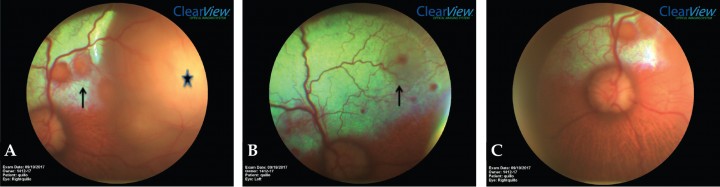 <p>Mismas imágenes que la figura 2. (A) Exploración mediante oftalmoscopia directa OD. Se observa desprendimiento de retina por acúmulo de exudado (asterisco) y lesiones multifocales en la zona tapetal (flecha). (B) Exploración mediante oftalmoscopia directa OS. En la zona tapetal se observan lesiones hiporreflectivas debido al exudado activo (flecha). (C) Detalle del OD, en el que el nervio óptico muestra signos de inflamación.</p>