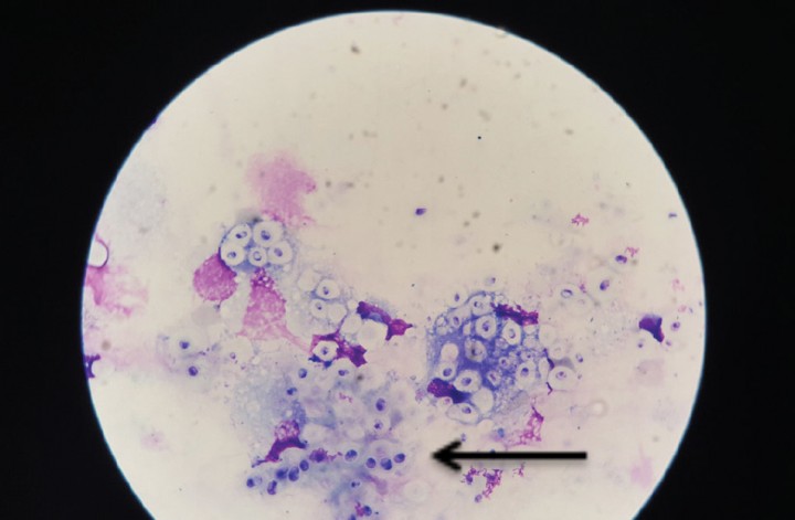 <div class=\"Basic-Text-Frame\">
<p>Citología (x100) del vítreo aspirado mediante vitreocentesis en la que se puede identificar <em>Cryptococcus</em> spp (flecha).</p>
</div>