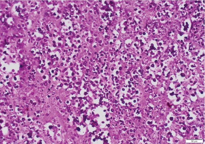 <p>Tinción PAS (x100) de la coroides, en la que <em>Cryptococcus</em> spp. adquiere un tono magenta al entrar en contacto el colorante con la cápsula de este.</p>