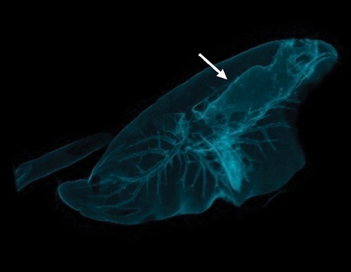 <div>
<p>Reconstrucción 3D del pulmón izquierdo. La flecha blanca señala el bronquio caudal izquierdo invadido por la masa.</p>
</div>