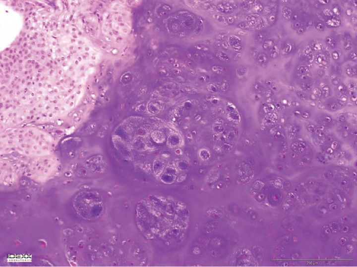 <p>Imagen microscópica de la lesión. Se observa una proliferación de células mesenquimatosas con abundante depósito de matriz condroide, lagunas con una o varias células de redondas a estrelladas, con bordes indefinidos, citoplasma moderadamente eosinófilo, núcleo redondo, cromatina granular gruesa y nucleolo central redondo, pequeño y basófilo (tinción HE x10).</p>
