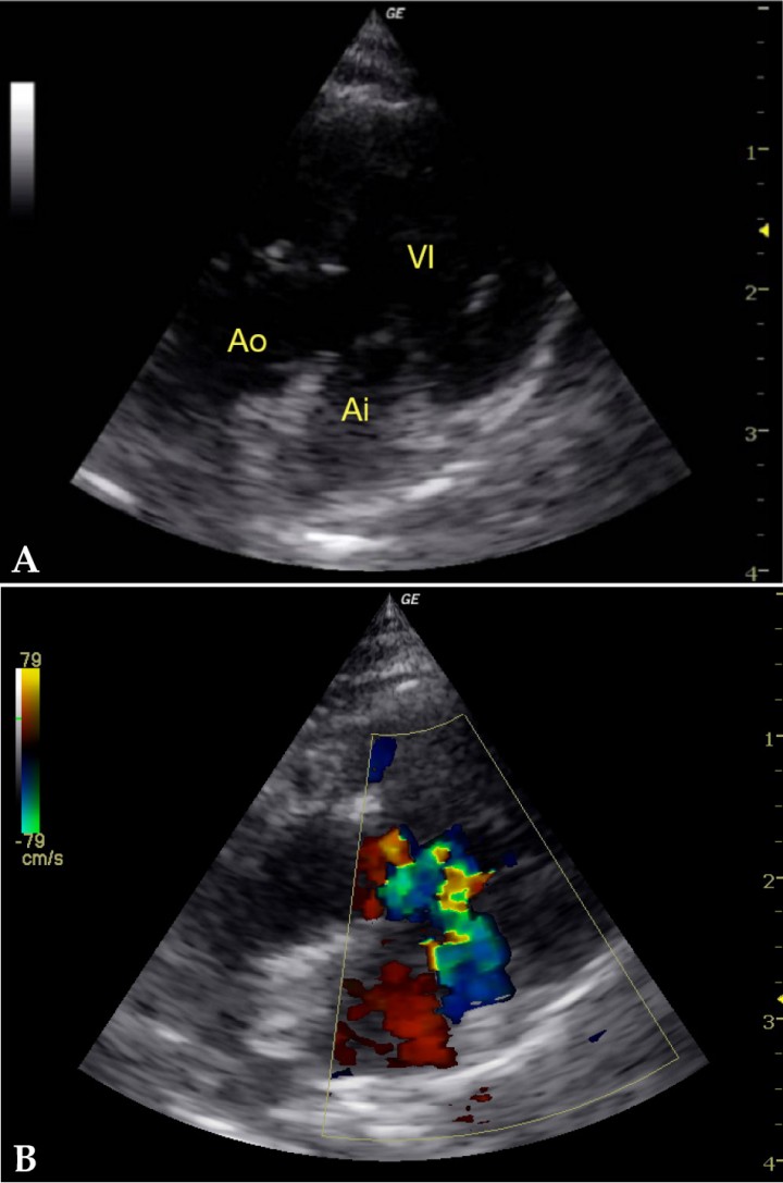 <p>Imagen de ecocardiografía. (<strong>A</strong>) Corte apical 5 cámaras lado izquierdo con escasa alineación por desituación del corazón en la caja torácica que muestra engrosamiento difuso de las paredes ventriculares. (<strong>B</strong>) Corte apical 5 cámaras lado izquierdo con Doppler color que muestra la presencia de obstrucción dinámica del tracto de salida izquierdo con movimiento sistólico anterior de la válvula mitral. AI: aurícula izquierda, VI: ventrículo izquierdo, Ao: aorta.</p>
