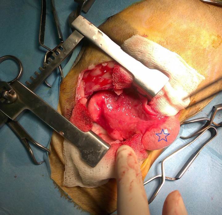 <p>Imagen de la toracotomía intercostal izquierda que muestra pulmón atelectásico y presencia de bulla enfisematosa en su polo distal (estrella).</p>