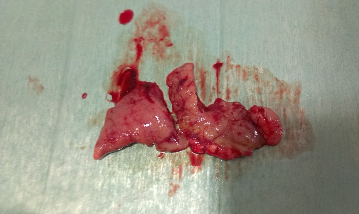 <div class=\"Basic-Text-Frame\">
<p>Imagen macroscópica del pulmón izquierdo atelectásico extirpado completamente.</p>
</div>