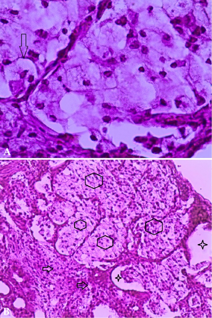 <p>Imágenes microscópicas del pulmón. (<strong>A</strong>) Se observa población macrofágica con amplio citoplasma de aspecto espumoso por la presencia de vacuolas lipídicas (flecha) (Hematoxilina-eosina; 100x). (<strong>B</strong>) Se aprecia la ocupación del espacio alveolar por macrófagos cargados de lípidos (hexágonos). Escasas regiones muestran aire en su interior (estrellas). La misma población macrofágica invade los septos interalveolares (flechas). (Hematoxilina-eosina; 40x). Imágenes cedidas por Histolab.</p>