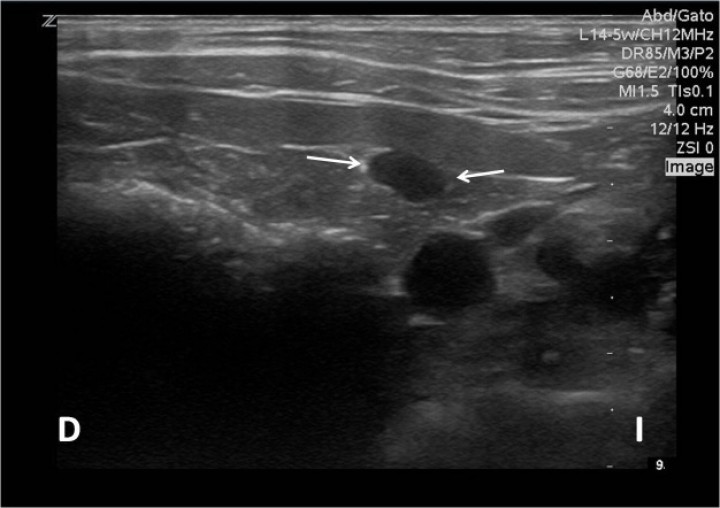 <div class=\"Basic-Text-Frame\">
<p>Imagen ecográfica en un corte transversal en abordaje ventral donde se observa una estructura tubular anecógena adyacente al bazo (flechas). D: derecha, I: izquierda.</p>
</div>
