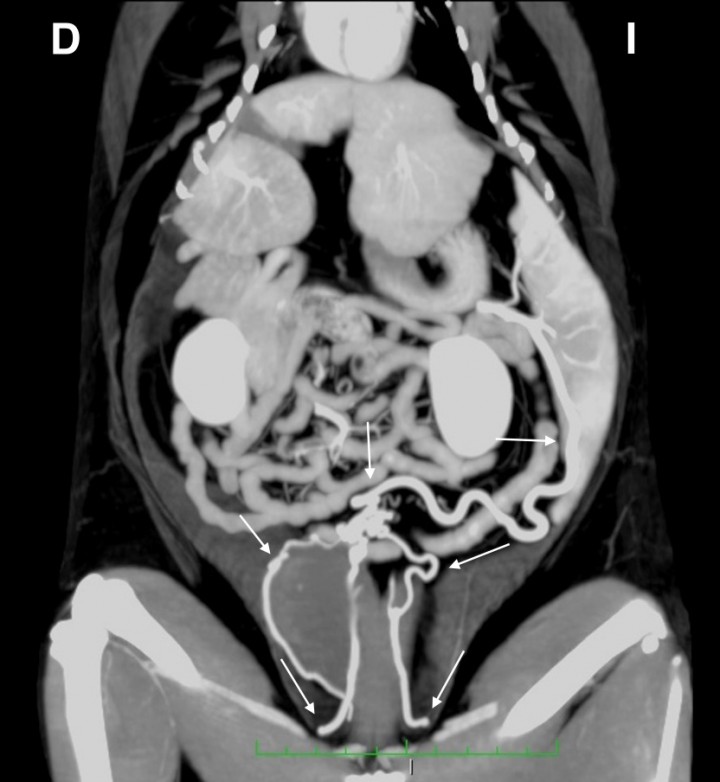 <p>Imagen tomográfica dorsal del abdomen tras la administración de contraste intravenoso, en ventana tejido blando y con proyección de máxima intensidad (MIP) con sumatorio de cortes. Se observa el recorrido de la comunicación desde su origen en la vena esplénica hasta su inserción múltiple en las venas ilíacas externas (flechas). D: derecha, I: izquierda.</p>