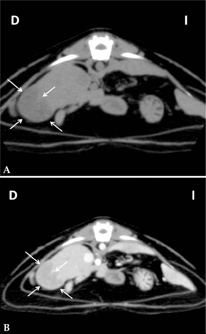 <p>Imagen tomográfica en corte transversal del abdomen en ventana tejido blando. (<strong>A</strong>) Secuencia precontraste. (<strong>B</strong>) Secuencia postcontraste intravenoso. Se observa una lesión hepática (flechas) de bordes irregulares e hipoatenuada que realza levemente tras la administración de contraste intravenoso. D: derecha, I: izquierda.</p>