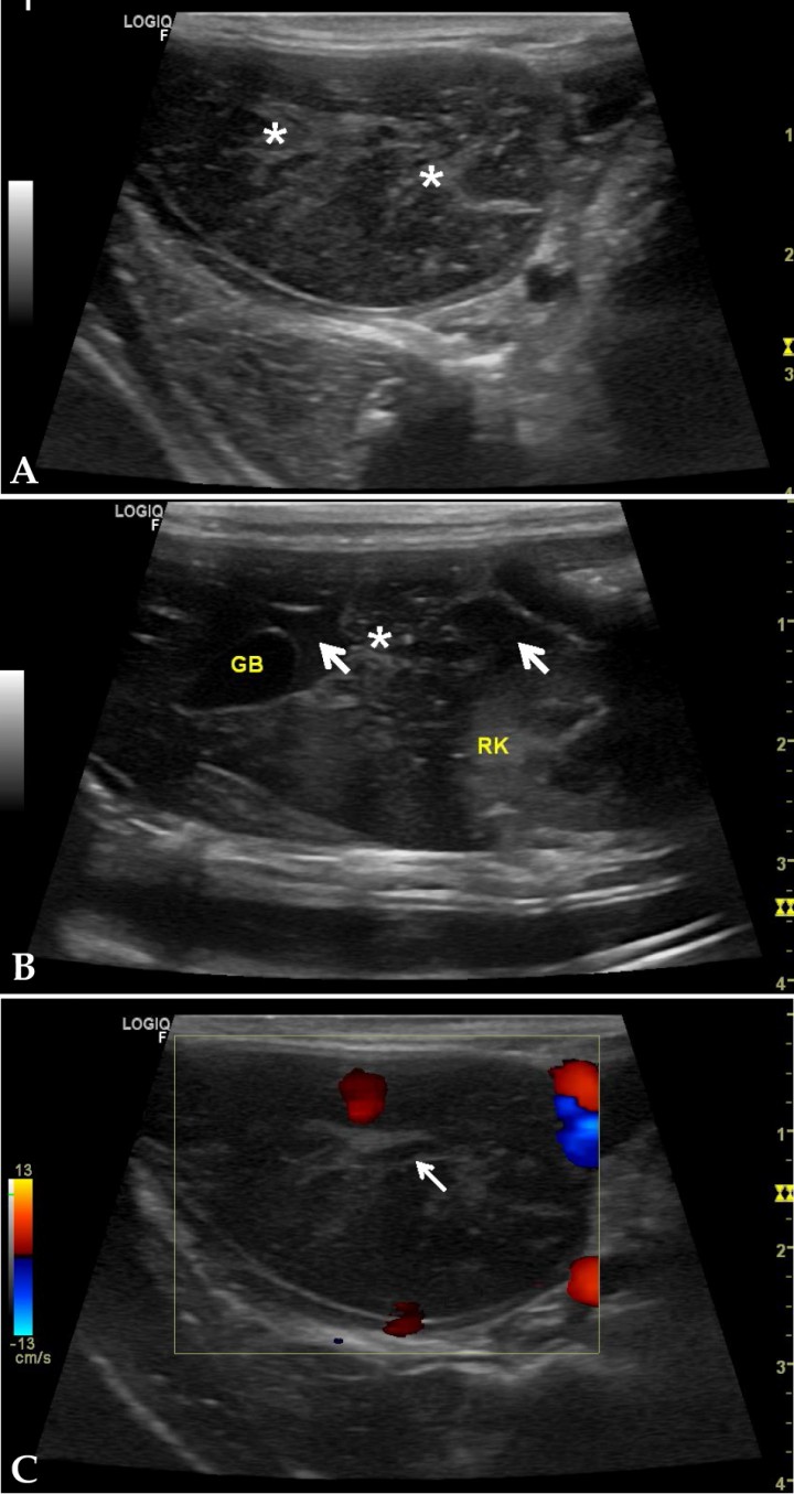 <p>Imágenes ecográficas del hígado en cortes longitudinales y parasagitales derechos. (<strong>A</strong>) Lóbulo hepático de ecogenicidad mixta (asteriscos sobre focos hiperecoicos), bordes redondeados, grasa mesentérica hiperecogénica. (<strong>B</strong>) Corte sagital a la altura de riñón derecho, presencia de contenido anecoico entre lóbulos (flechas blancas), área hepática con contorno irregular y ecogenicidad mixta (asterisco). (<strong>C</strong>) Corte longitudinal a nivel del hilio hepático utilizando el Doppler color sobre lóbulo afectado. Nótese ausencia de flujo en vena de paredes ecogénicas, vaso porta (flecha blanca). GB: vesícula biliar; RK: riñón derecho.</p>