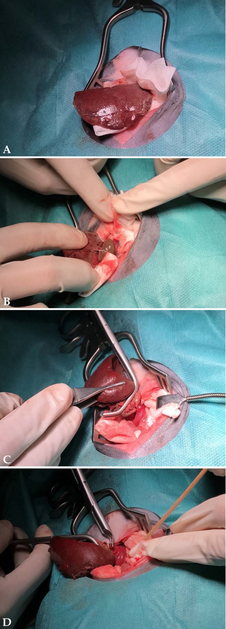 <p>Imágenes macroscópicas del lóbulo caudado afectado durante la cirugía. (<strong>A</strong>) Aspecto del lóbulo caudado durante la cirugía; se aprecia congestión y cambio de coloración del lóbulo torsionado. Presencia de contenido fibrinoso en superficie y aspecto rugoso. (<strong>B</strong>) Visualización del hilio vascular durante la cirugía; se observa el estrangulamiento de los vasos que irrigan el lóbulo afectado. (<strong>C</strong>) Previa a la ligadura del hilio vascular, los vasos torsionados se aseguran a través de un <em>clamp</em> vascular Satinsky. (<strong>D</strong>) Ligadura del pedículo vascular con hemoclips de titanio de 6,2 mm; se emplazaron un total de 3 hemoclips.</p>