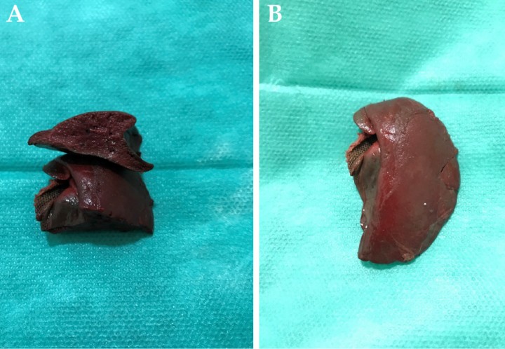 <p>(<strong>A</strong> y <strong>B</strong>) Aspecto macroscópico del lóbulo caudado torsionado tras su extracción. Nótese el parénquima hepático de color más mate, superficie rugosa y tejido friable.</p>