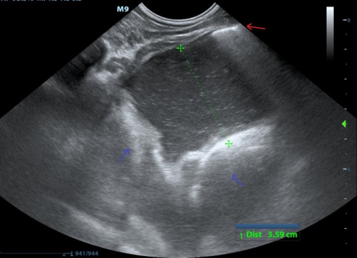 <div>
<p>Ecografía TFAST. Línea de reverberación compatible con signo de deslizamiento pleural (flecha roja), y espacio anecoico con ecos en suspensión, compatible con líquido pleural (punteado verde). En zonas más profundas se observa una zona pleural engrosada (flechas azules).</p>
</div>