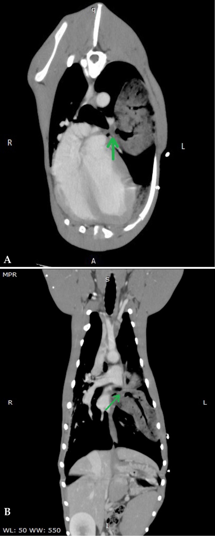 <p>(<strong>A</strong>) Corte transversal en ventana tejido blando. (<strong>B</strong>) Corte dorsal en ventana tejido blando. Se observa la porción caudal del lóbulo craneal izquierdo torsionada a nivel del hilio. El lóbulo aparece consolidado, aumentado de volumen y mal posicionado. El bronquio aparece interrumpido a nivel del hilio (flechas verdes).</p>