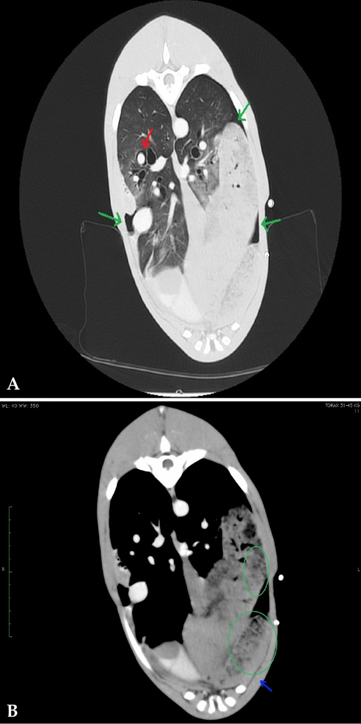 <p>(<strong>A</strong>) Corte transversal en ventana pulmón. (<strong>B</strong>) Corte transversal en ventana tejido blando. Lóbulo pulmonar torsionado (flecha azul) con patrón vesicular visible en la porción caudal del lóbulo craneal izquierdo (círculo verde). Pequeño volumen de aire en espacio pleural (flechas verdes) y de enfisema intersticial alrededor de la arteria pulmonar del lóbulo caudal derecho (flecha roja).</p>