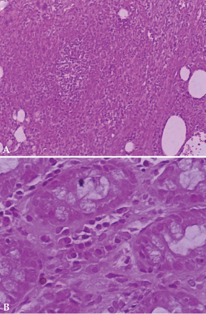 <p>Histopathological evaluation of panniculitis and concurrent inflammatory bowel disease in a dog. (<strong>A</strong>) Photomicrograph. Nodular to septal, pyogranulomatous panniculitis (Haematoxylin and eosin x200). (<strong>B</strong>) Photomicrograph. Lymphoplasmacytic colitis. Excessive mononuclear infiltrate in lamina propria of mucosa (Haematoxylin and eosin x400).</p>