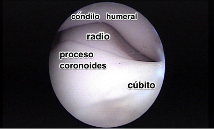<p>Imagen de artroscopia de un codo normal en un Border Collie de 10 meses de edad. Nótese el aspecto perfectamente liso y regular del cartílago articular y el grosor homogéneo del mismo.</p>
