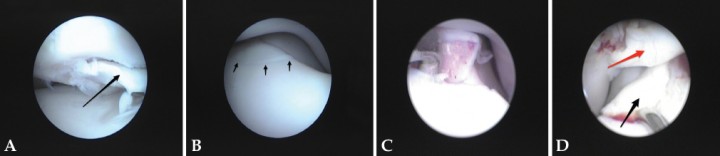 <p>(<strong>A</strong>) Imagen de artroscopia de un Pastor del Cáucaso de 6 meses de edad mostrando un fragmento de cartílago semidesprendido (flecha) en un caso de OCD de cóndilo humeral. (<strong>B</strong>) Imagen de artroscopia de un Golden Retriever de 9 meses. Se detecta una fisura (flechas) en el ápex del proceso coronoides medial que podría haber pasado desapercibida durante una artrotomía. (<strong>C</strong>) Imagen del mismo animal de la Figura 2B. Aspecto del ápex del proceso coronoides una vez desencajado completamente de su lecho con un palpador. Se puede apreciar el grosor del hueso subcondral. Posteriormente, se procedió a su extracción y al legrado de la zona. (<strong>D</strong>) Imagen de artroscopia en un caso de PCF y OCD simultáneos. Movilización del proceso coronoides fragmentado con un palpador (flecha negra). La parte medial del cóndilo humeral muestra una lesión de OCD (flecha roja), con el fragmento de cartílago todavía <em>in situ</em>.</p>