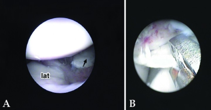 <p>(<strong>A</strong>) Imagen de artroscopia. Exploración del compartimento lateral de un codo afectado de OCD. Se aprecia el proceso coronoides lateral (lat) y un fragmento de cartílago de una OCD (flecha) que se había deslizado desde el área medial, donde estaba la lesión. No inspeccionar toda la articulación podría haber conllevado la no retirada del fragmento, como posiblemente hubiera ocurrido con una artrotomía. (<strong>B</strong>) Imagen de artroscopia. Extracción del fragmento de cartílago en una OCD de codo en el animal de la Figura 5. El lecho subcondral queda ahora expuesto mostrando algunas áreas hemorrágicas.</p>
